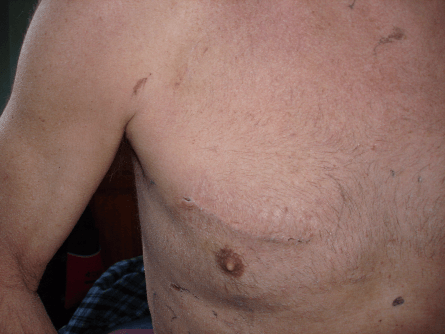 Close up of the wound only 2 weeks after surgery