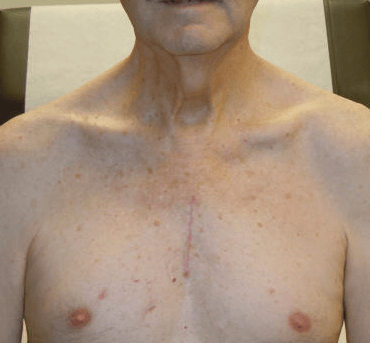 Mini-sternotomy incision approximately 3 weeks after the surgery