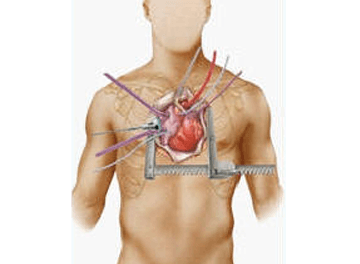 “Minimally Invasive” Heart Surgery