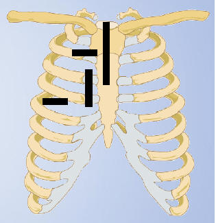 Possible Incision Sites