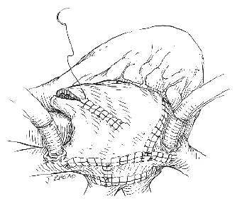 Incisions and Suturing for the original Cox-Maze Procedure