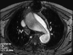 Chronic Aortic Dissection