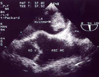 TEE (Trans-Esophageal Echocardiogram) showing a left atrial myxoma