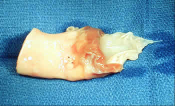Aortic Homograft (Human Cadaver Valve and a Portion of the Ascending Aorta)