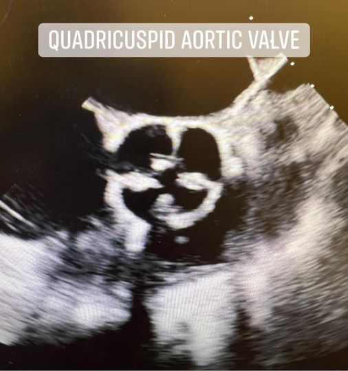 Quadricuspid Aortic Valve