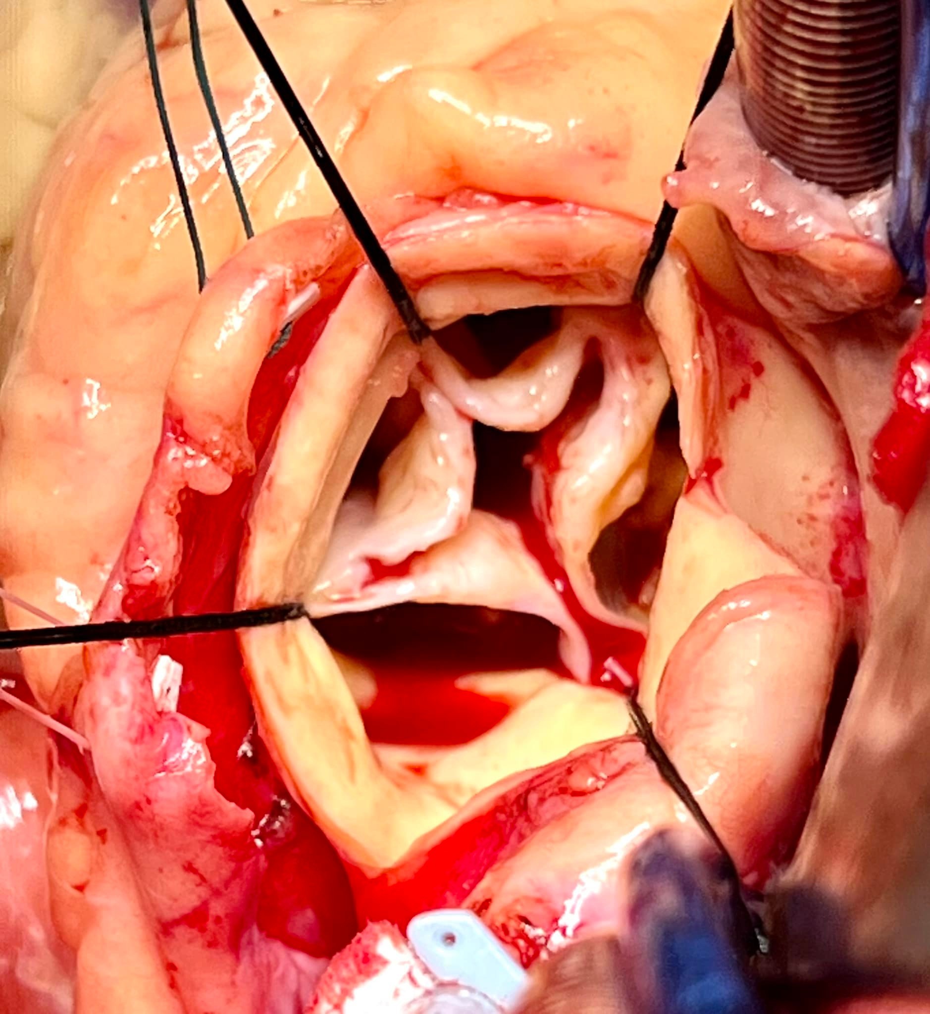 Quadricuspid Aortic Valve