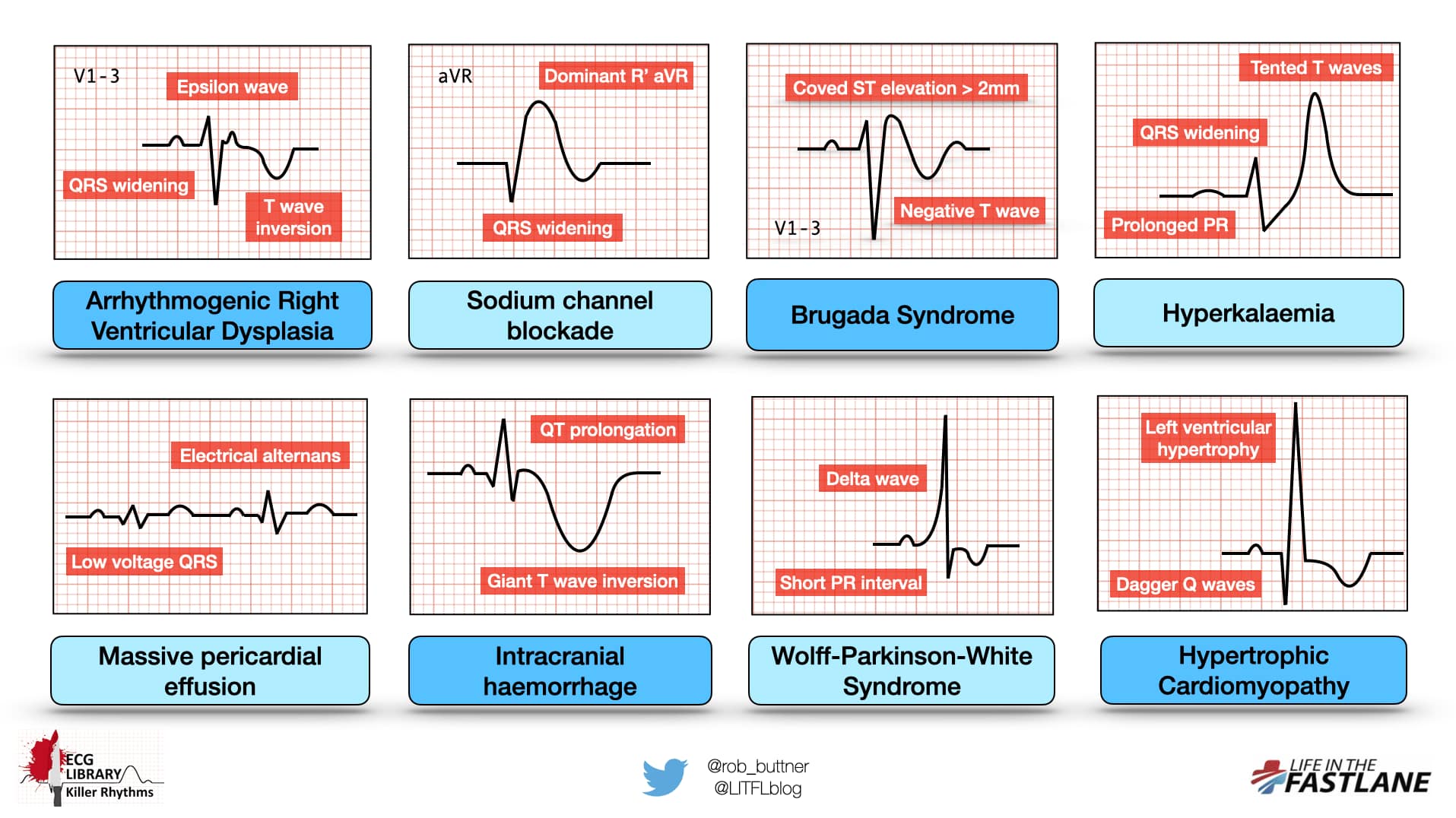 What Do Ekg Results Look Like