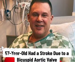 Stroke from Bicuspid Aortic Valve