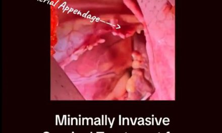 Minimally Invasive Surgery for AFIB