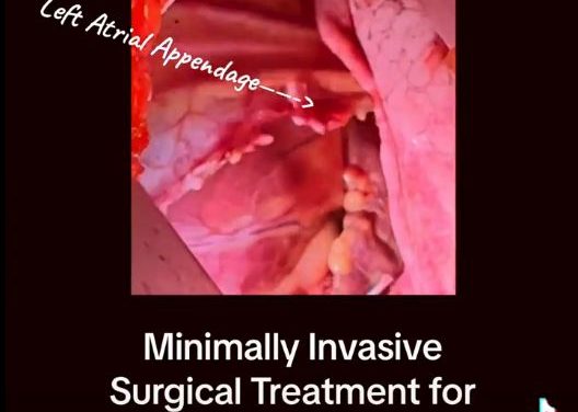 Minimally Invasive Surgery for AFIB