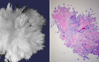 Cardiac papillary fibroelastoma