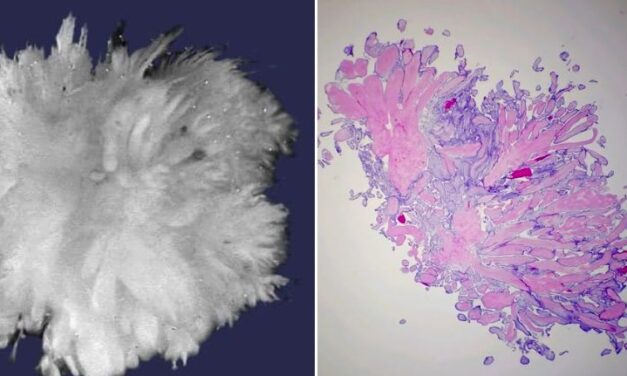 Cardiac papillary fibroelastoma