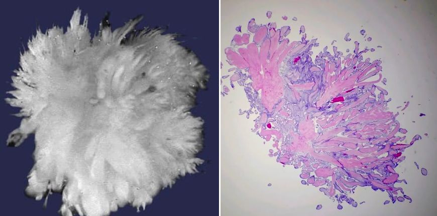 Cardiac papillary fibroelastoma