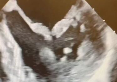 Barlow’s Disease: Complex Mitral Valve Repair