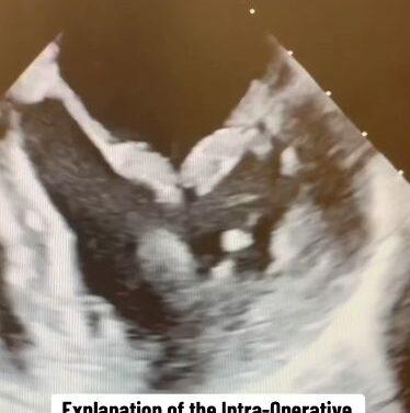 Barlow’s Disease: Complex Mitral Valve Repair