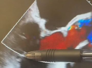 Mitral Valve Repair Over Replacement