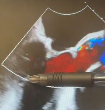 Mitral Valve Repair Over Replacement