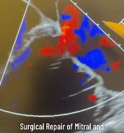 Mitral and Tricuspid Valve Repair