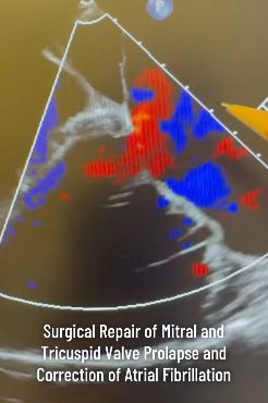 Mitral and Tricuspid Valve Repair