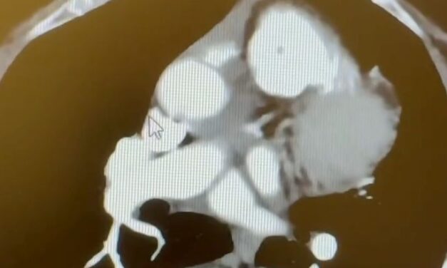 Sinus of Valsalva Aneurysm Repair