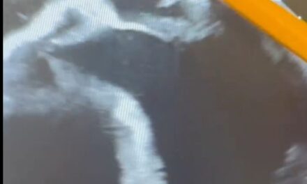 Mitral Valve Prolapse and Repair