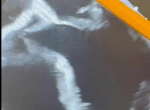 Mitral Valve Prolapse and Repair